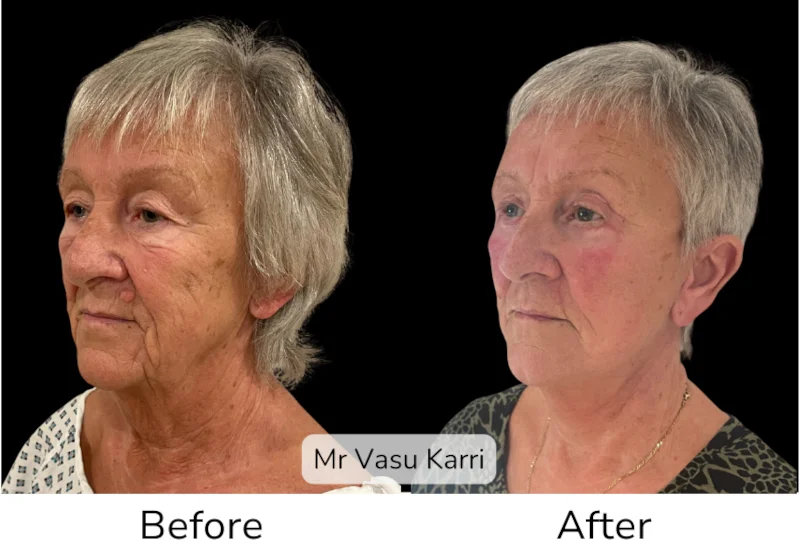 Facelift Patient 10 View 3